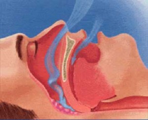 Severe Sleep Apnea blocked air passage