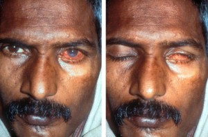 sleeping with open eyes - lagophthalmos