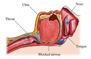 hypopnea