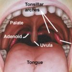 How well does a tonsillectomy cure sleep apnea?
