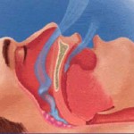 Severe Sleep Apnea