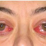 People Sleeping with Their Eyes Open