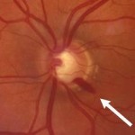 Sleep Apnea Symptoms May Affect Your Vision