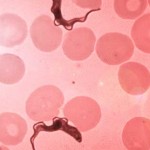 Sleeping Sickness Symptoms